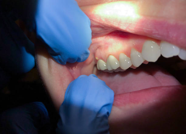 Best Emergency Dental Care for Broken or Chipped Teeth in , WA